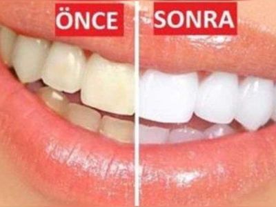Sarı dişler nasıl beyazlatılır? Ev yapımı doğal ve bitkisel karışımlar ile sarı dişleri beyazlatma yöntemleri