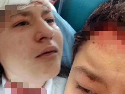 Selfie Kurbanı: Kastamonu'da 14 Yaşındaki Kız Çocuğuna 5 Köpek Saldırdı!
