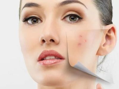Sivilce izlerini nasıl geçiririm diyenler buraya! Sivilce izleri nasıl geçer? İşte mucize çözüm