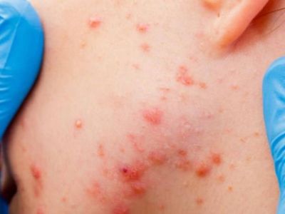 Sivilceleri geçmeyenler dikkat: Tiroid hastalığına sebep olabilir! Bir bardak suyla test yapabilirsiniz
