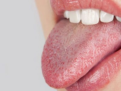 Sjögren sendromu nedir, belirtileri nelerdir? Tedavi edilmediğinde körlüğe yol açan sjögren sendromunun 8 belirtisi