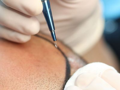 Smile Haır Clinic Uzman Doktoru Dr. Mehmet Erdoğan; Ütopik Sonuçlar Vaat Etmiyoruz