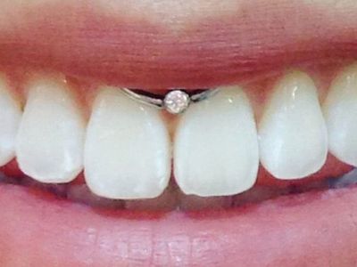 Smiley Piercing Zararları Nelerdir?
