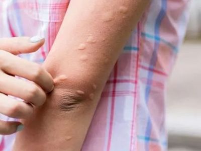 Tatile çıkacaklar dikkat: Sıtma vakaları giderek artıyor