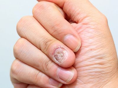 Tırnak tümörü nedir, belirtileri nelerdir, nasıl tedavi edilir?