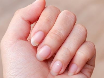 Tırnakta beyaz lekeler neden olur, hangi hastalığın habercisi? Lökoniki böbrek yetmezliğinin habercisi