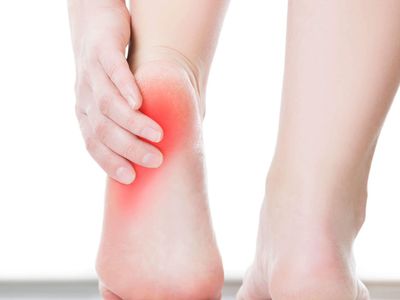 Topuk dikeni nedir, neden olur? Topuk dikeni ağrısını yok edecek doğal ve bitkisel tedavi yöntemleri