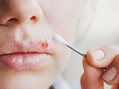Uçuk neden çıkar, nasıl geçer, hangi hastalıkların belirtisidir? Evde uçuğu geçiren en hızlı çözümler