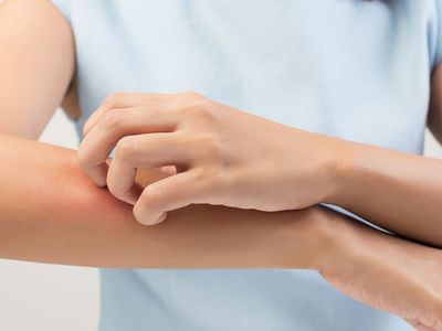 Uyuz hastalığı nedir, belirtileri neler? Uyuz hastalığında döküntü ve kaşıntıları geçirmek için öneriler