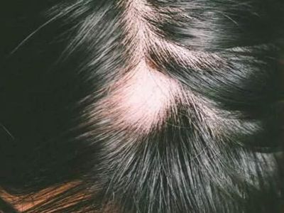 Will Smith’in karısının hastalığı Alopesi nedir? Alopecia sebepleri neler, neden olur, nasıl anlaşılır, tedavisi var mı?