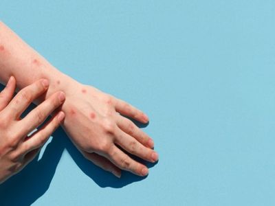 Yabancı Uyruklu Şahsa ''Maymun Çiçeği'' Testi Yapıldı: Sonuç Ne Çıktı?