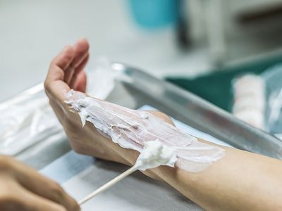 Bu Hatayı Yapmayın: Yanıklara Uygulanan Yanlış Müdahale Kalıcı Sorunlara Neden Oluyor
