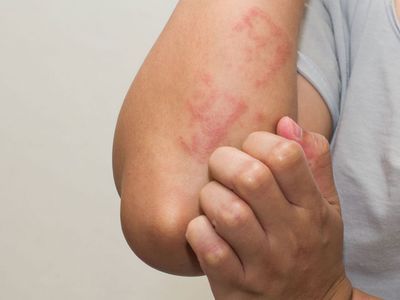 Zona hastalığı nedir, zona hastalığının belirtileri nelerdir?