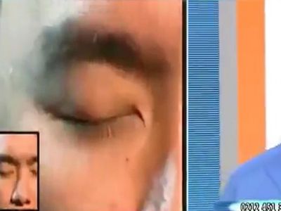 Soğan ve Sarımsağı Yüzüne Sürdü, Yüzündeki Kurtlar Döküldü!