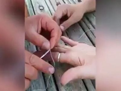 Parmakta Sıkışan Yüzüğü Çıkarma Operasyonu