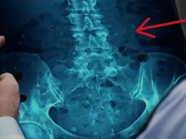3 gündür tuvalete çıkamayan adamın makatından pet şişe çıktı! Meğer karısından utandığı için...