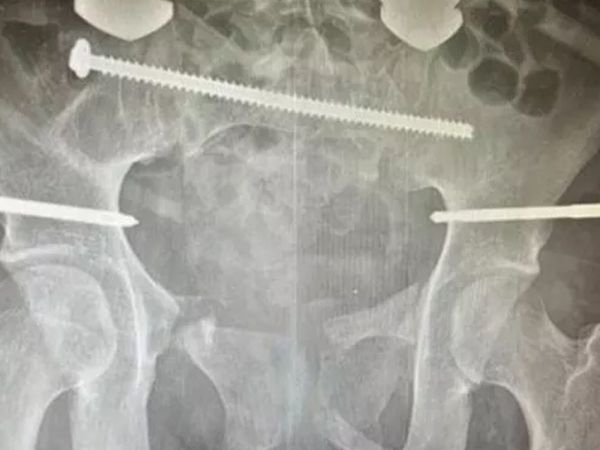 Böylesi daha önce görülmedi! Vücudu ikiye ayrılan kadın için doktorlar yaşama ihtimali yüzde sıfır demişti son hali herkesi şaşırttı