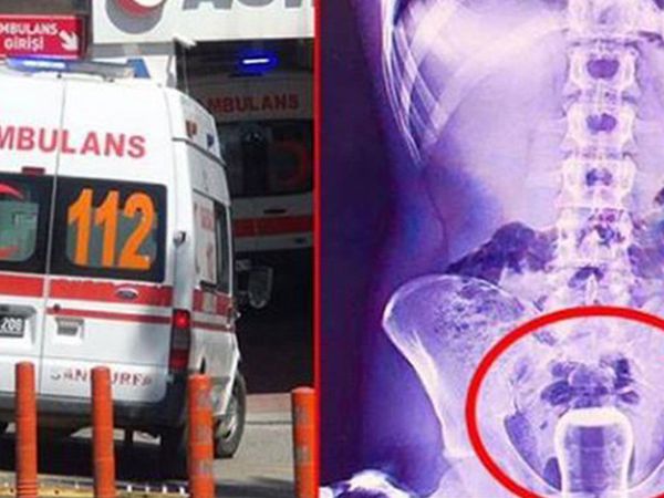 'Bu buraya nasıl girdi?' diyeceğiniz birbirinden garip röntgen filmleri!