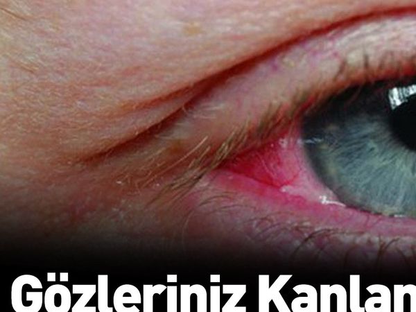Gözünüzün kanlanmasını ihmal etmeyin kör olabilirsiniz!