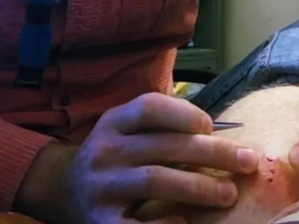 Kolunsaki şişlik yüzünden doktora gitti hayatını şokunu yaşadı: Sivilce zannetmişti ama öyle bir şey çıktı ki
