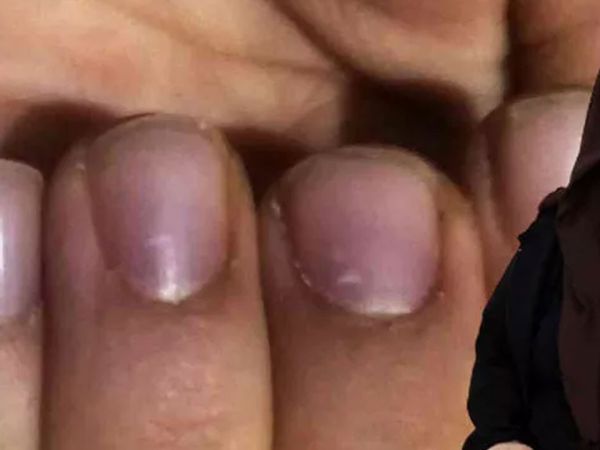 Sakarya'da ilginç bir vaka! Elleri ayakları bir anda morarıyor hastalığının adı bile yok