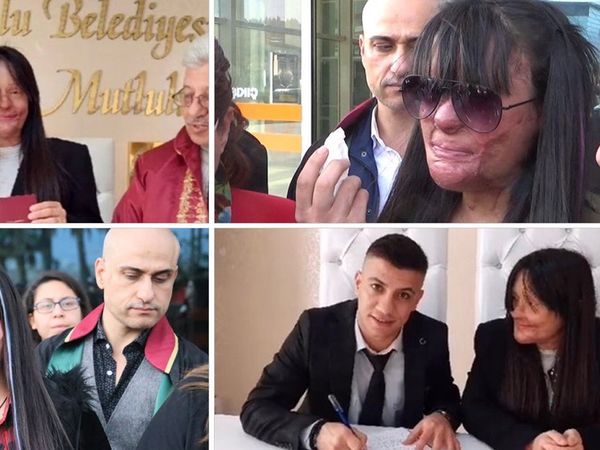Yüzünü Yakan Kişiyle Evlenen Berfin Özek’in Babası Konuştu