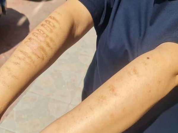 İzmit'te skandal olay: Epilasyon için gittiği güzellik merkezinde kolları yandı!
