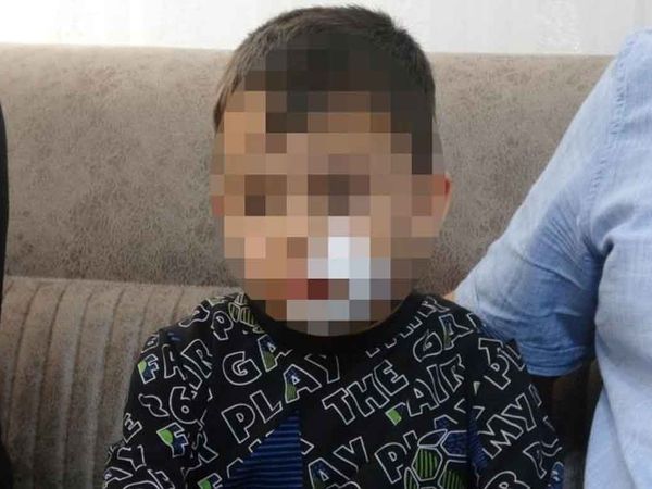 Niğde’de başıboş köpek terörü: 6 yaşındaki anaokulu öğrencisine 11 dikiş atıldı!
