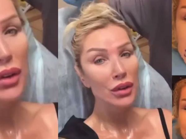 Seda Sayan estetik yaptırdığı anları canlı paylaştı