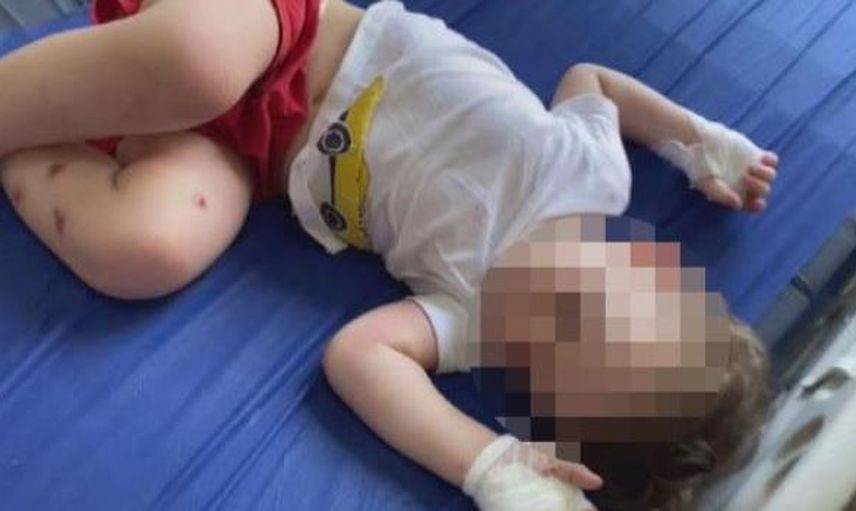 Öz Babası Tarafından Üzerinde Sigara Söndürülen 1,5 Yaşındaki Bebeğin Durumu Kötü!
