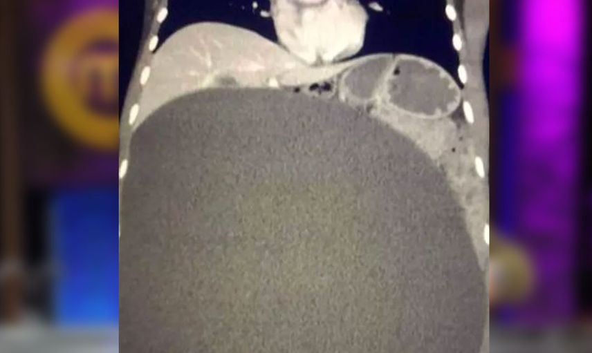 Kilo aldın diye azarlayıp geri gönderdiler! Zavallı kadının karnından çıkan şeyler doktorları bile utandırdı
