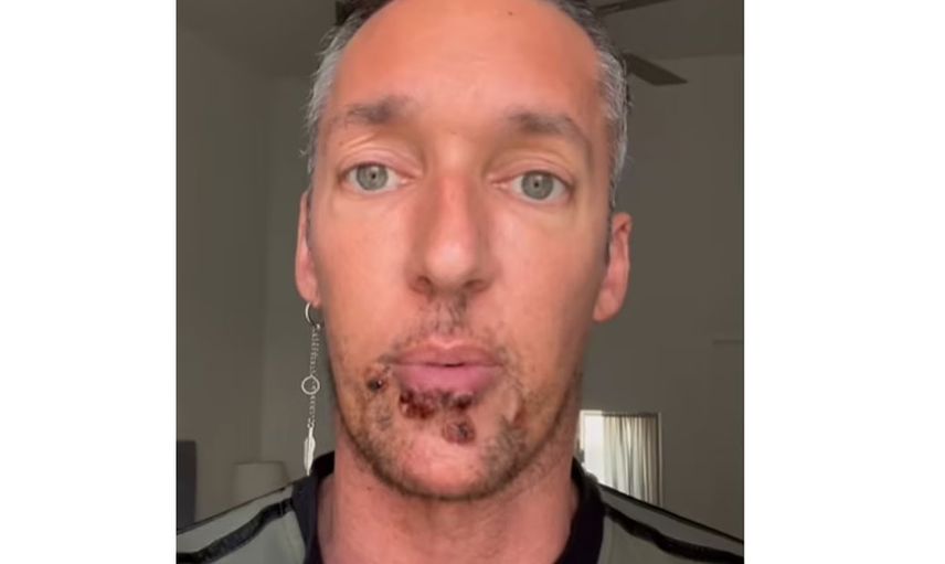 Öyle bir hastalığa yakalandı ki talihsiz adam burnunu kaybetti!