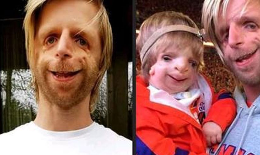 Yeni doğan bebeklerinin yüzünü görünce hastaneden kaçtılar: Jono Lancaster'ın hikayesi herkesi duygulandırdı