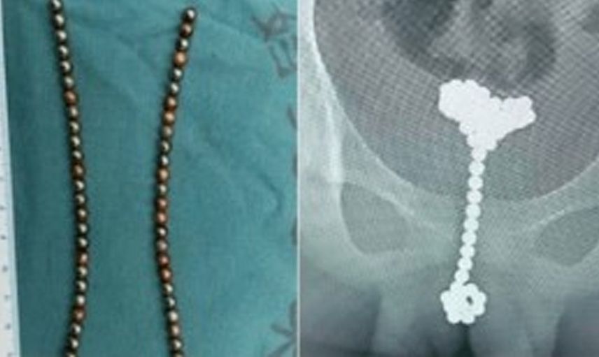 14 yaşındaki çocuk erkeklik organına 53 tane manyetik top soktu