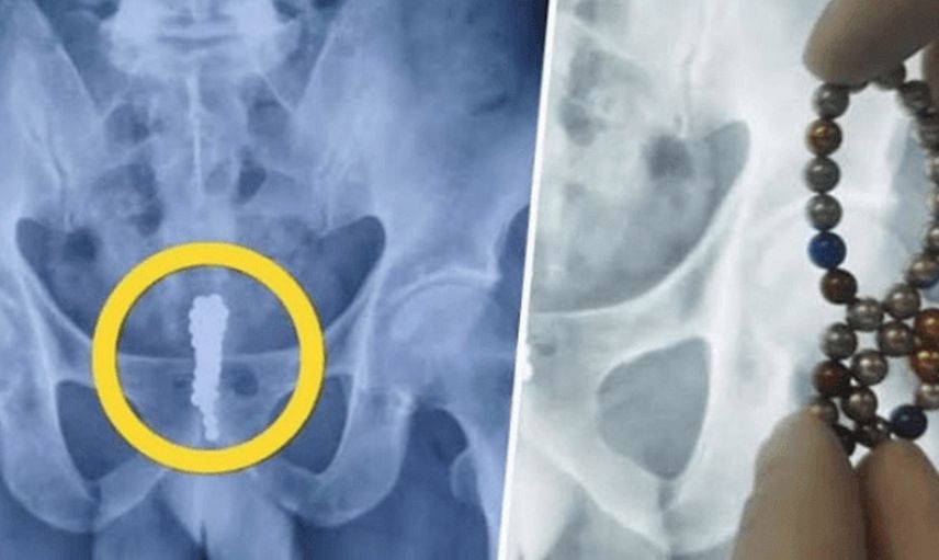 14 yaşındaki çocuk erkeklik organına 53 tane manyetik top soktu