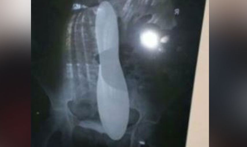 Ağrıların normal dediler eve gönderdiler Meğer hastanın karnında mala unutmuşlar!