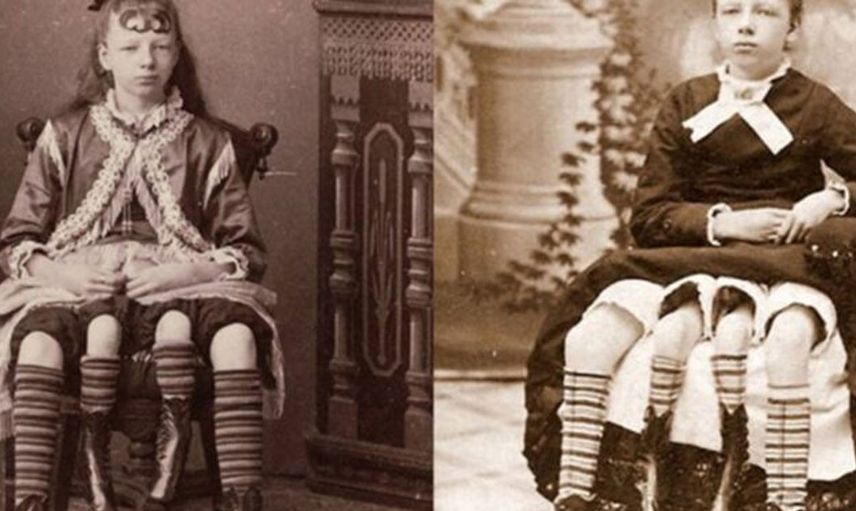 Dört bacak ve iki rahimle doğan kadın Myrtle Corbin'nin hayat hikayesi
