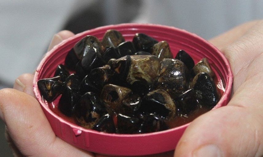 Safra Kesesi Taşı Neden Olur, Safra Kesesi Taşı Belirtileri Neler?