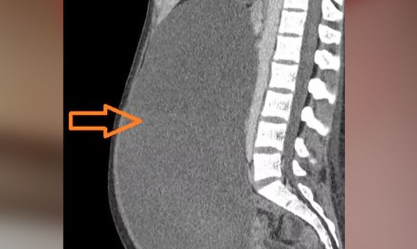 Kilo aldın diye azarlayıp geri gönderdiler! Zavallı kadının karnından çıkan şeyler doktorları bile utandırdı
