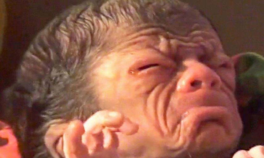 3 günlük bebek erken yaşlanma hastalığına yakalandı