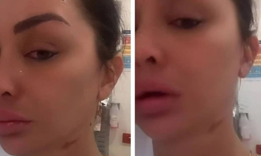 Canlı yayında korkunç olay! Tiktok fenomenin yüzüne asit attılar