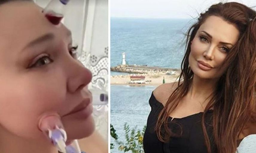 Yerli Adriana Lima Umut Akyürek güzelleşmek için yüzüne sülük yapıştırdı bin pişman olan Akyürek'in o hali herkese ders oldu