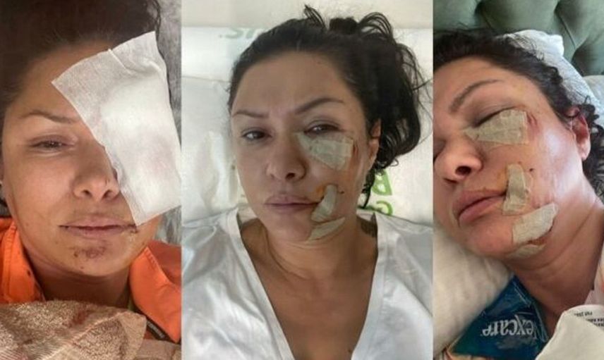 Şarkıcı Tuğba Altıntop'tan kötü haber! Köpek saldırısına uğradı: Son hali sevenlerini üzdü