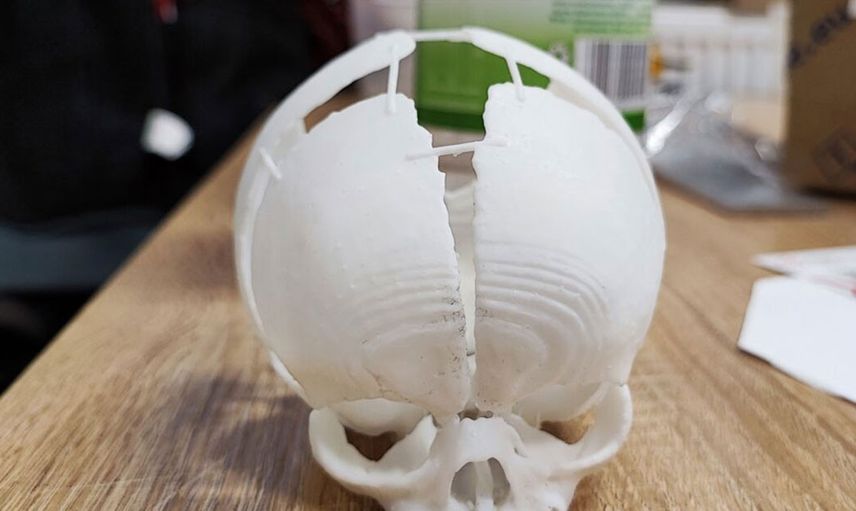 Teknoloji daha ne kadar ilerleyecek! Kafatası olmayan bebek 3D yazıcı ile yapay kafatasına sahip olarak hayatta kaldı