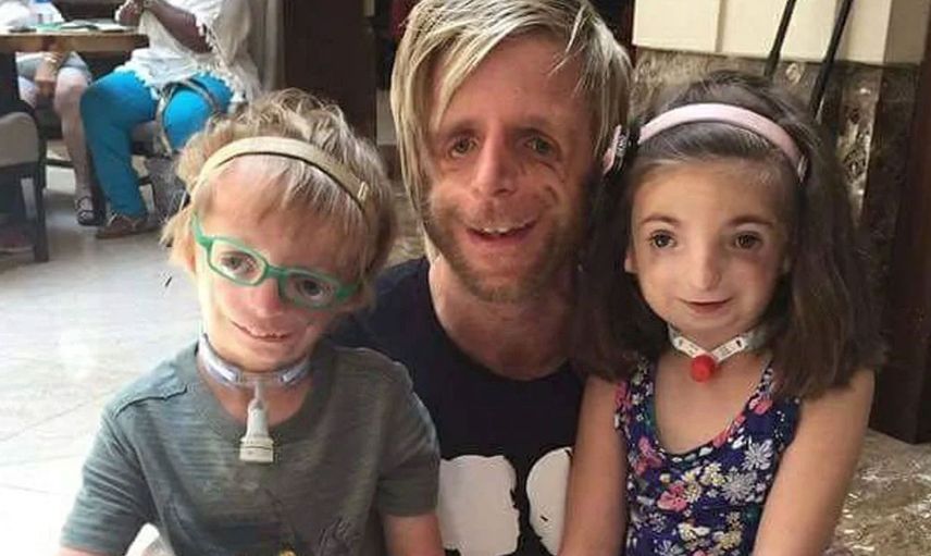 Yeni doğan bebeklerinin yüzünü görünce hastaneden kaçtılar: Jono Lancaster'ın hikayesi herkesi duygulandırdı