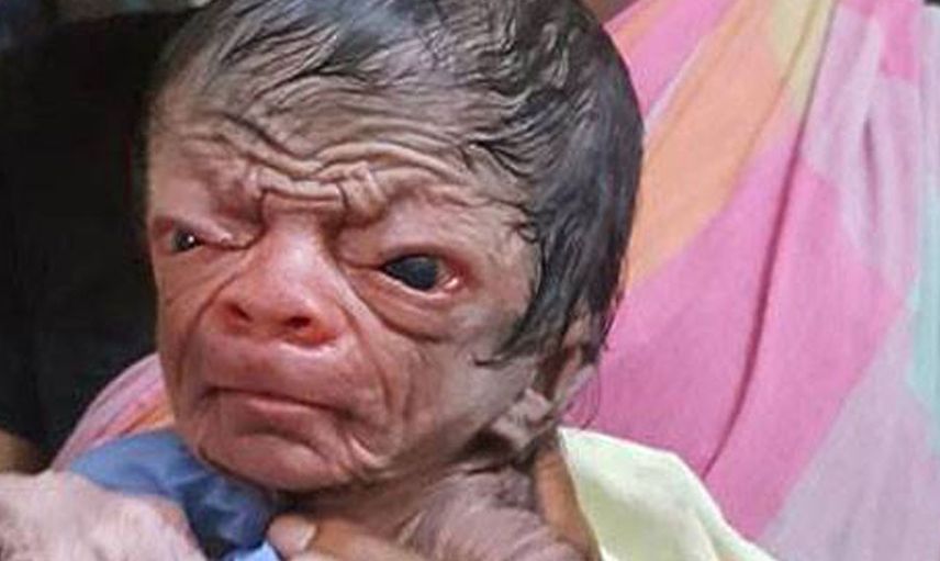 3 günlük bebek erken yaşlanma hastalığına yakalandı