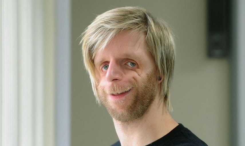 Yeni doğan bebeklerinin yüzünü görünce hastaneden kaçtılar: Jono Lancaster'ın hikayesi herkesi duygulandırdı
