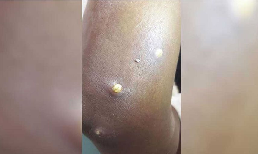 Larva oldukları ortaya çıktı