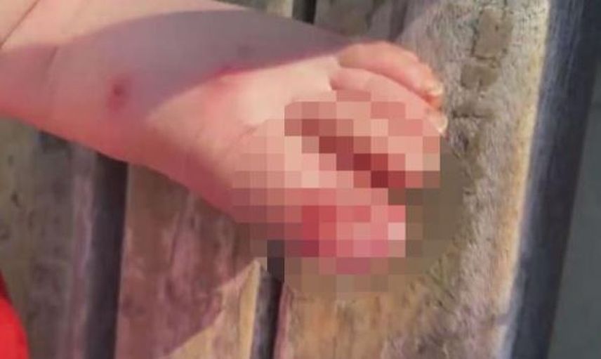 Öz Babası Tarafından Üzerinde Sigara Söndürülen 1,5 Yaşındaki Bebeğin Durumu Kötü!
