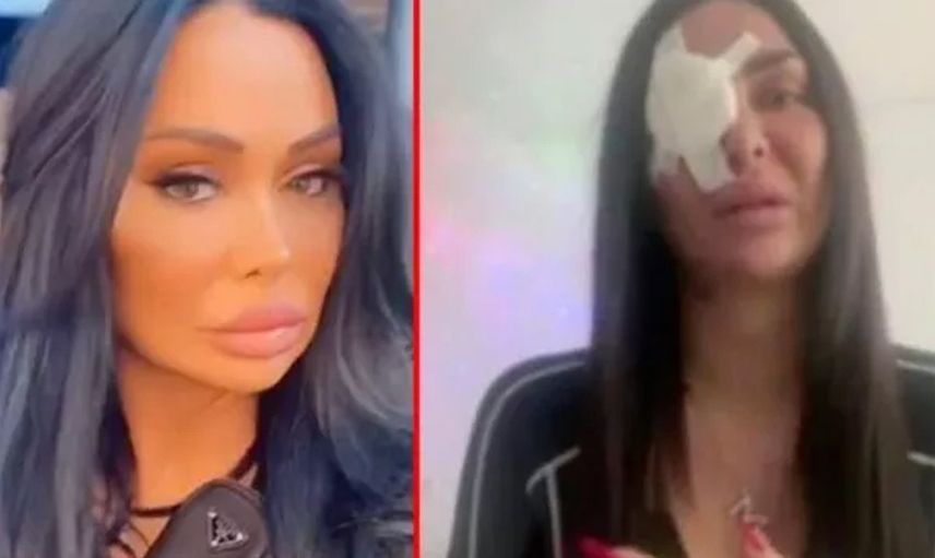 Canlı yayında korkunç olay! Tiktok fenomenin yüzüne asit attılar